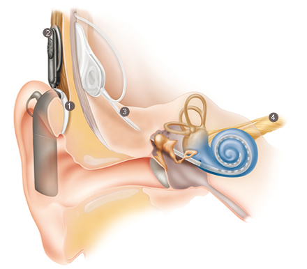 人工内耳はどのように機能しますか